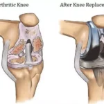 Do You Think You Need A Knee Replacement?